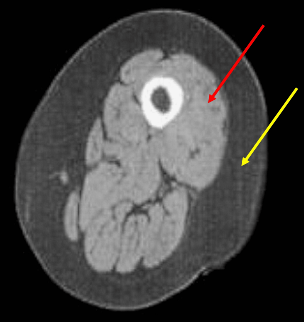 Chronic Obstructive Pulmonary Disease and Overtraining Syndrome: A Narrative Review