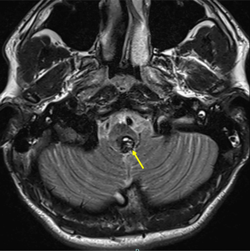 Pediatric Area Postrema Cavernoma: Clinical Presentation With Hiccups and Vomiting
