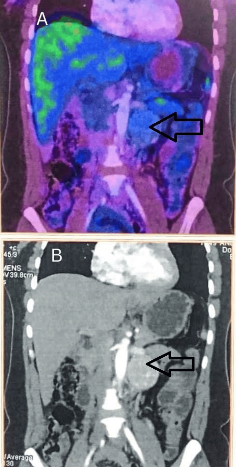 A Case of Functional Para-Aortic Paraganglioma Causing Accelerated Hypertension in an HIV-Positive Patient With Negative 68Ga-DOTATATE PET/CT Findings: Successful Laparoscopic Management