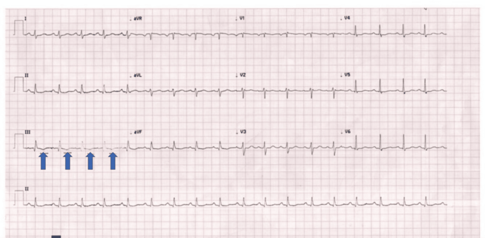 Multidisciplinary Management of Massive Pulmonary Embolism in Twin Pregnancy Using Percutaneous Thrombectomy: Maternal-Fetal Survival