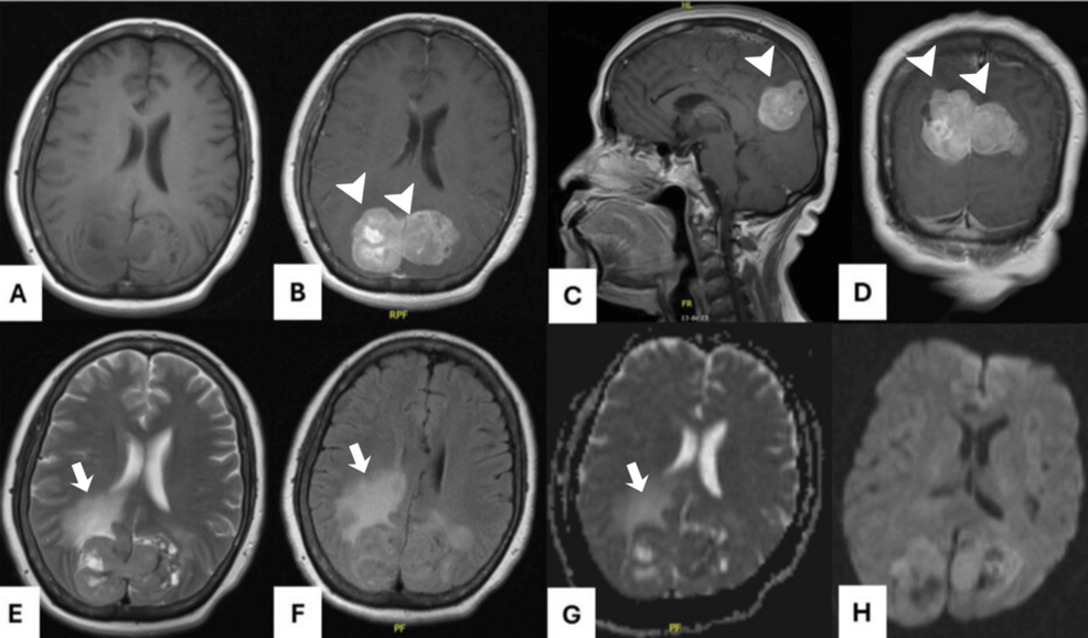 Solitary Fibrous Tumors of the Central Nervous System: A Retrospective Study From a National Referral Hospital in Mexico