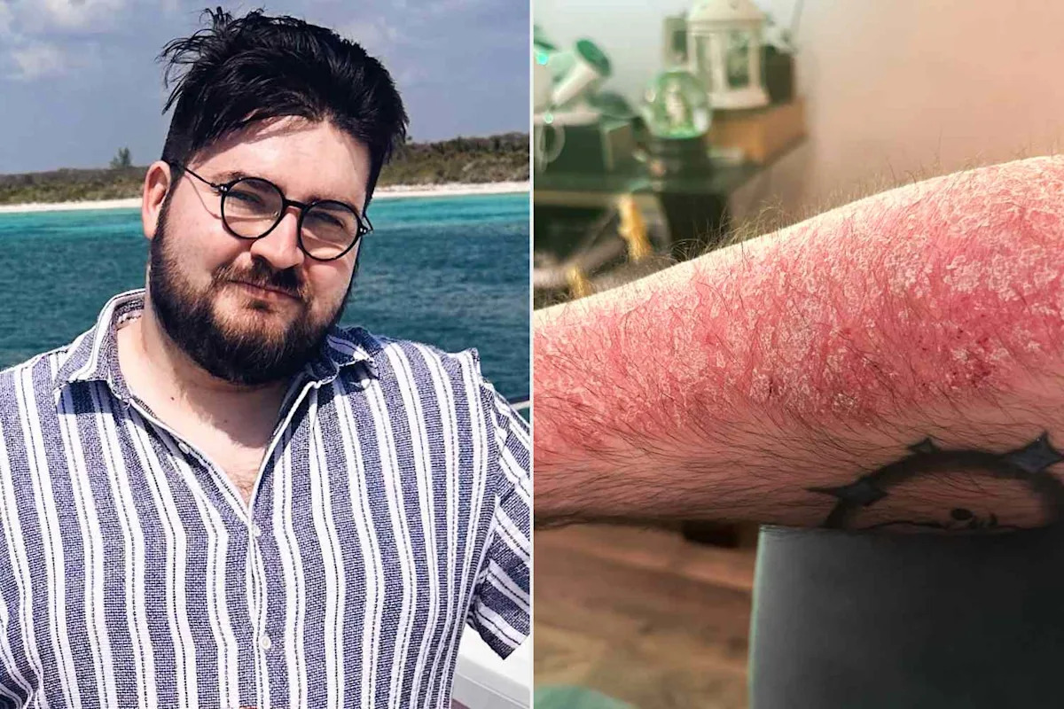Man Recalls ‘Emotional Toll’ of Having Psoriasis as a Teen: ‘It Was Very Difficult to Live and Be Out in the World’ (Exclusive)
