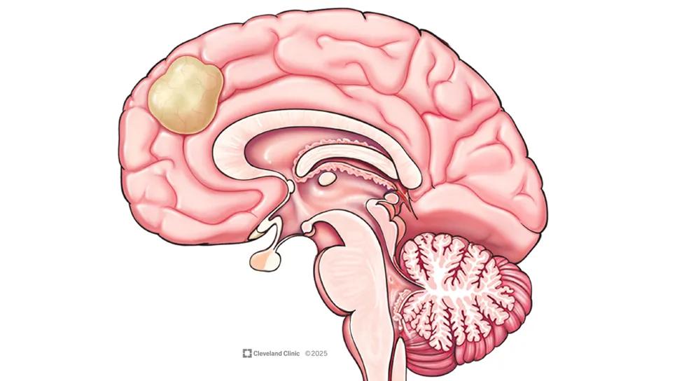 Eflornithine + Lomustine Extends Survival in Glioma Subtype