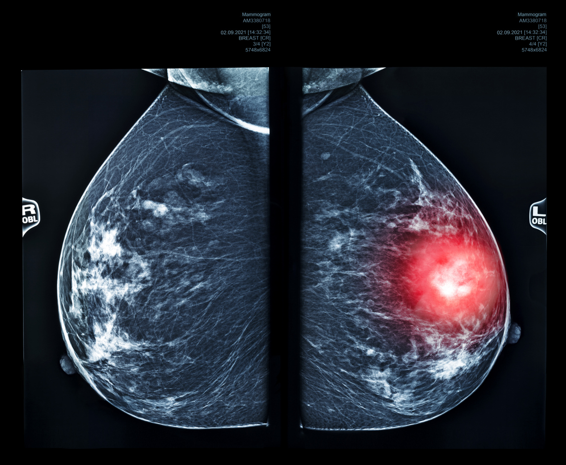 Google AI matches radiologists in detecting breast cancer in scans