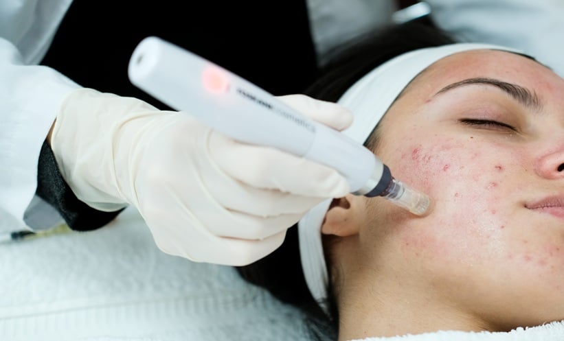 Laser vs Microneedling for Post-Acne Scars