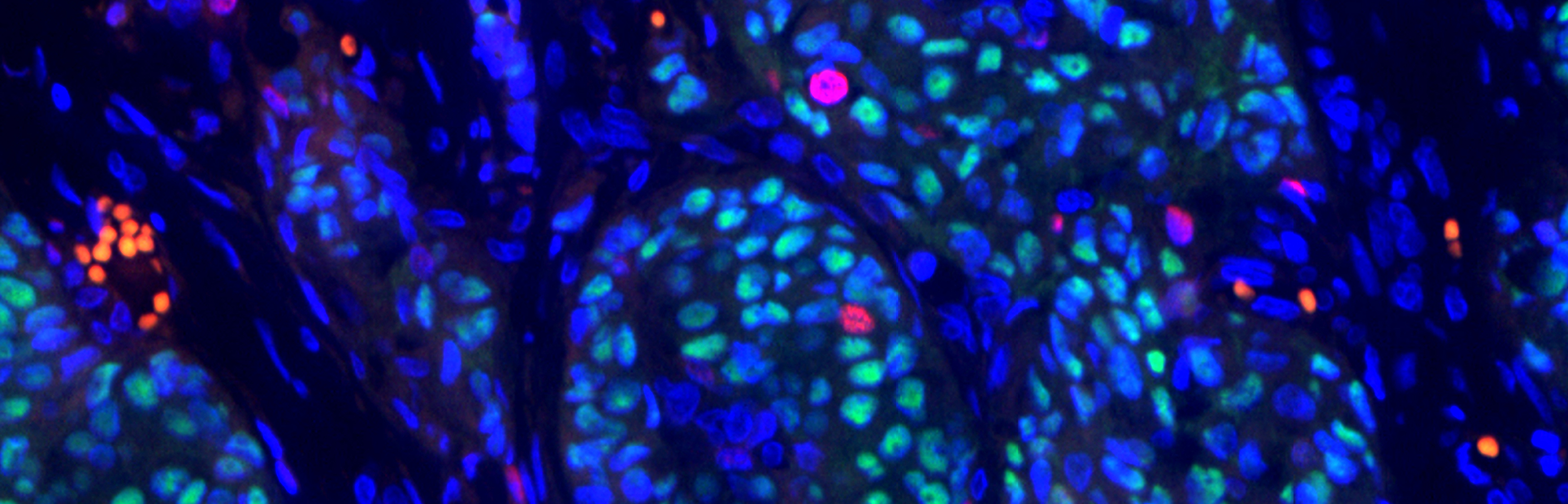 Bringing proteins together to take cancer apart