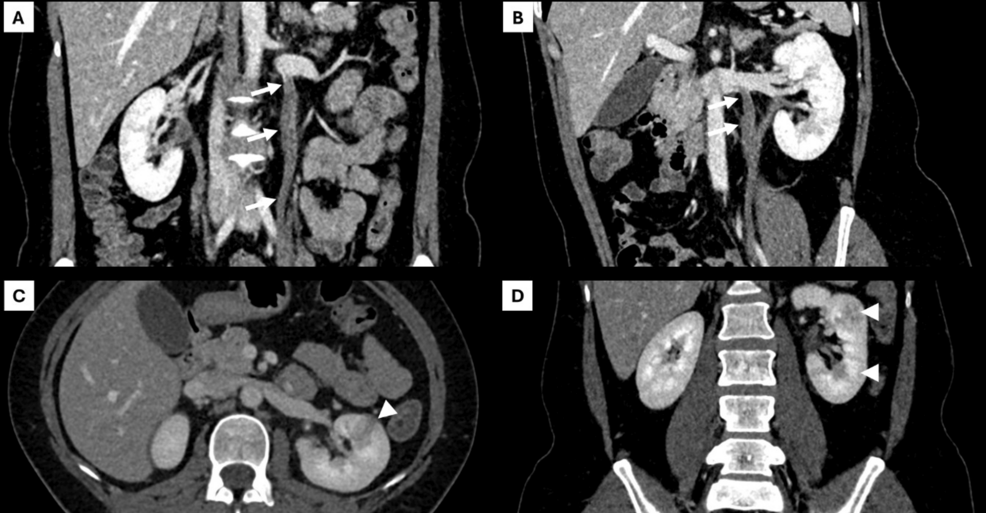 A Case of Non-obstetric Ovarian Vein Thrombosis Associated With Acute Pyelonephritis Presenting to the Emergency Department