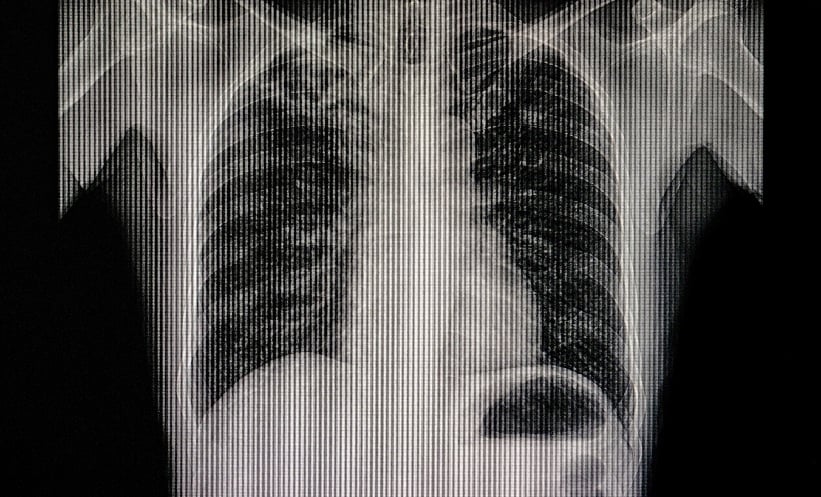 AI-Assisted Chest X-Rays in TB Detection Across LMICs