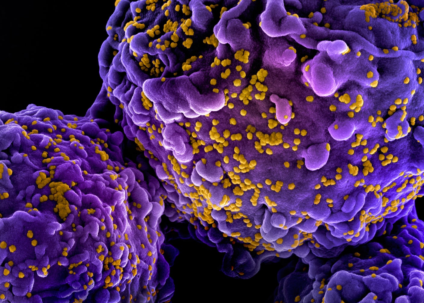 Norwegian Man Cured of HIV by His Brother’s Stem Cells