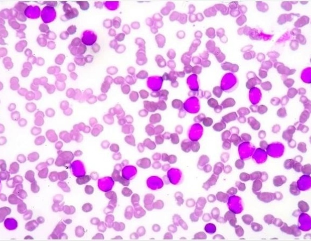 ASH releases updated recommendations for severe acquired aplastic anemia care