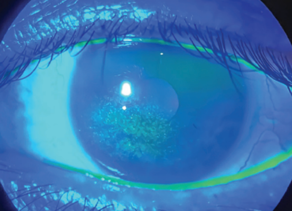 Neurotrophic Keratitis: Hiding in Plain Sight