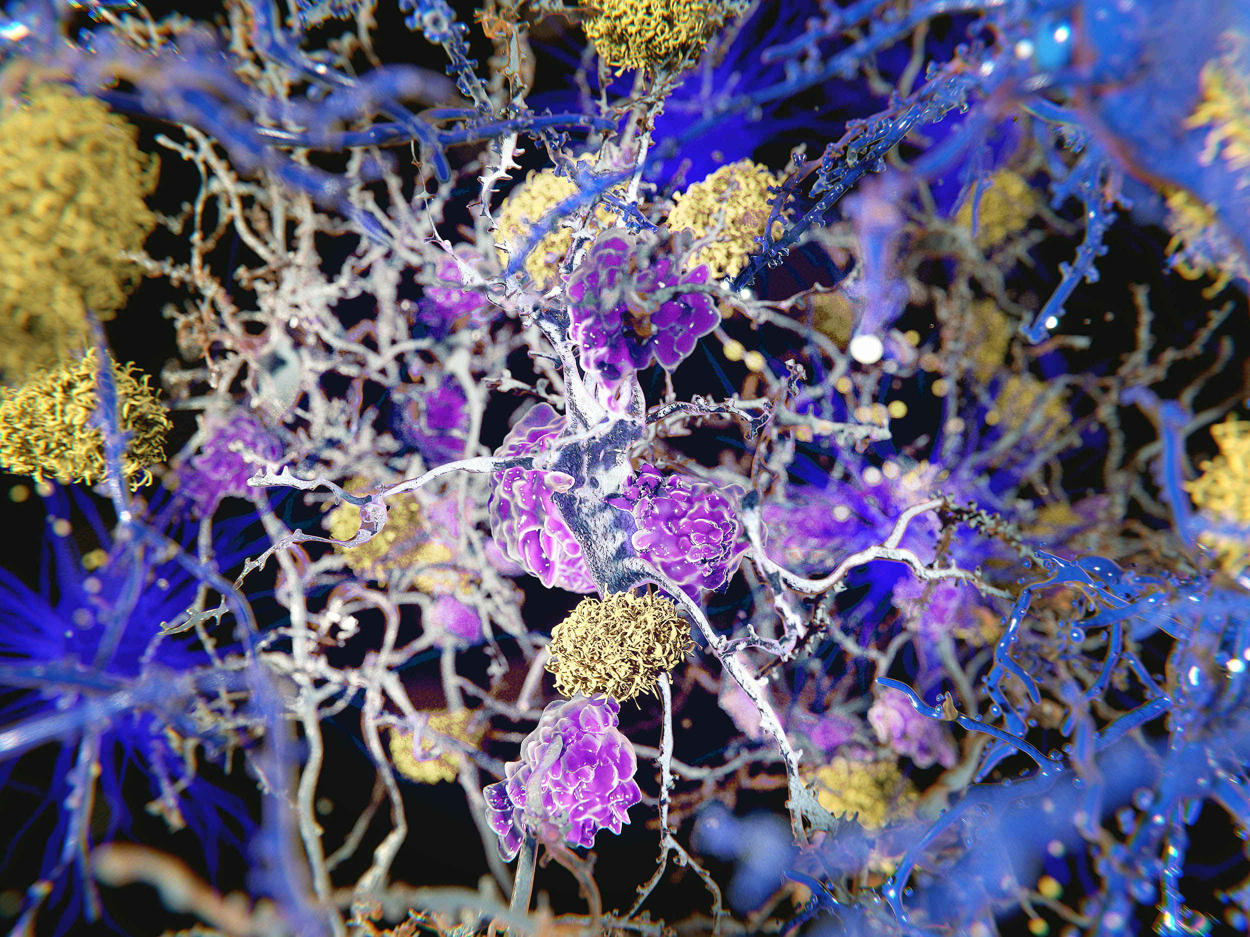 Alzheimer’s may start in body tissue inflammation, not in the brain