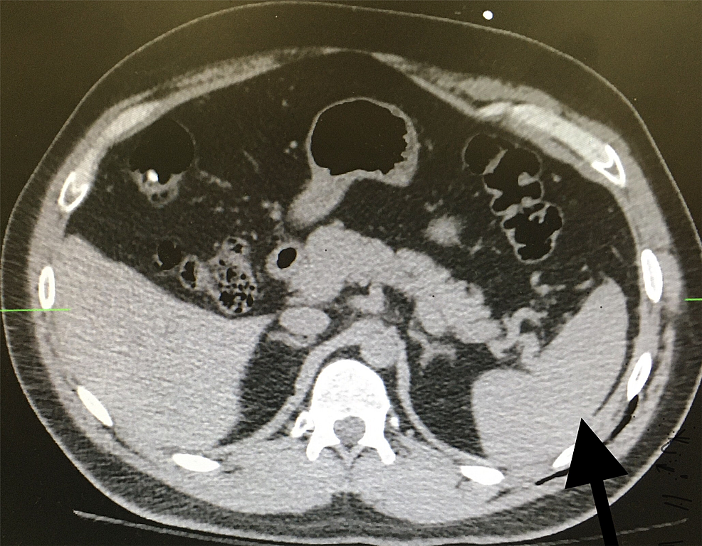 Delayed Spleen Rupture After Trauma