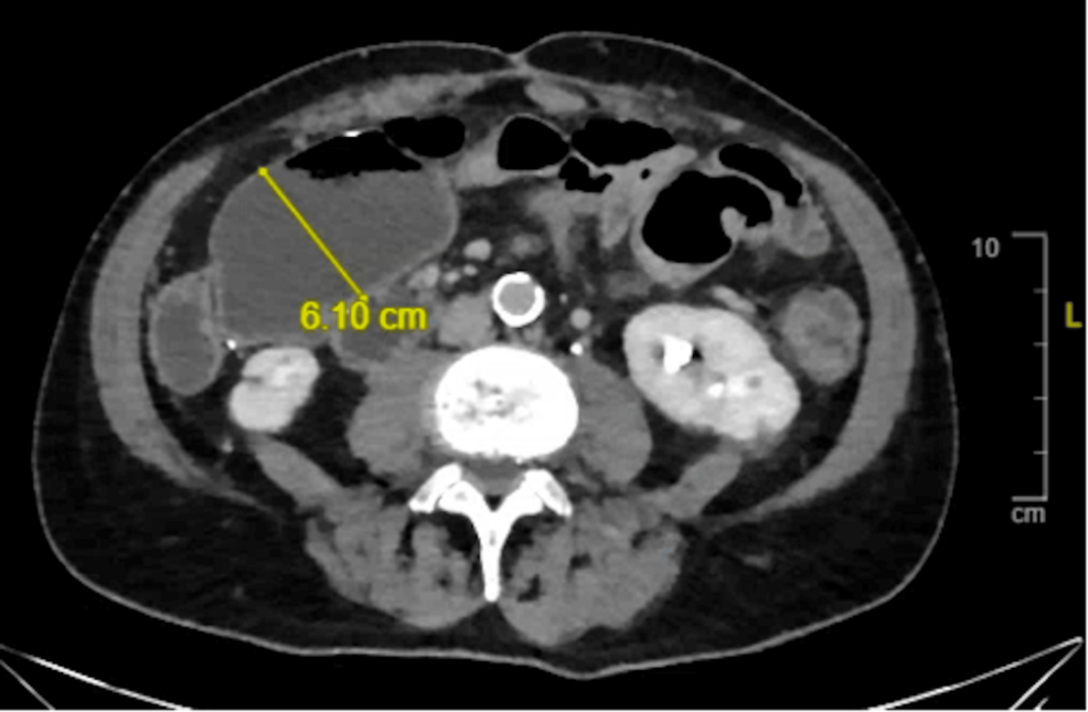 High-Grade Small Bowel Dysplasia Following Prior Adenocarcinoma in Small Bowel Crohn’s Disease