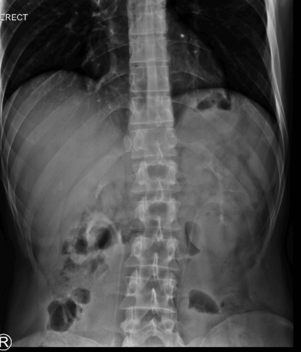 Life-Threatening Internal Hernia Through an Omental Band With Closed-Loop Obstruction in a Virgin Abdomen and Normal Laboratory Findings: A Case Report