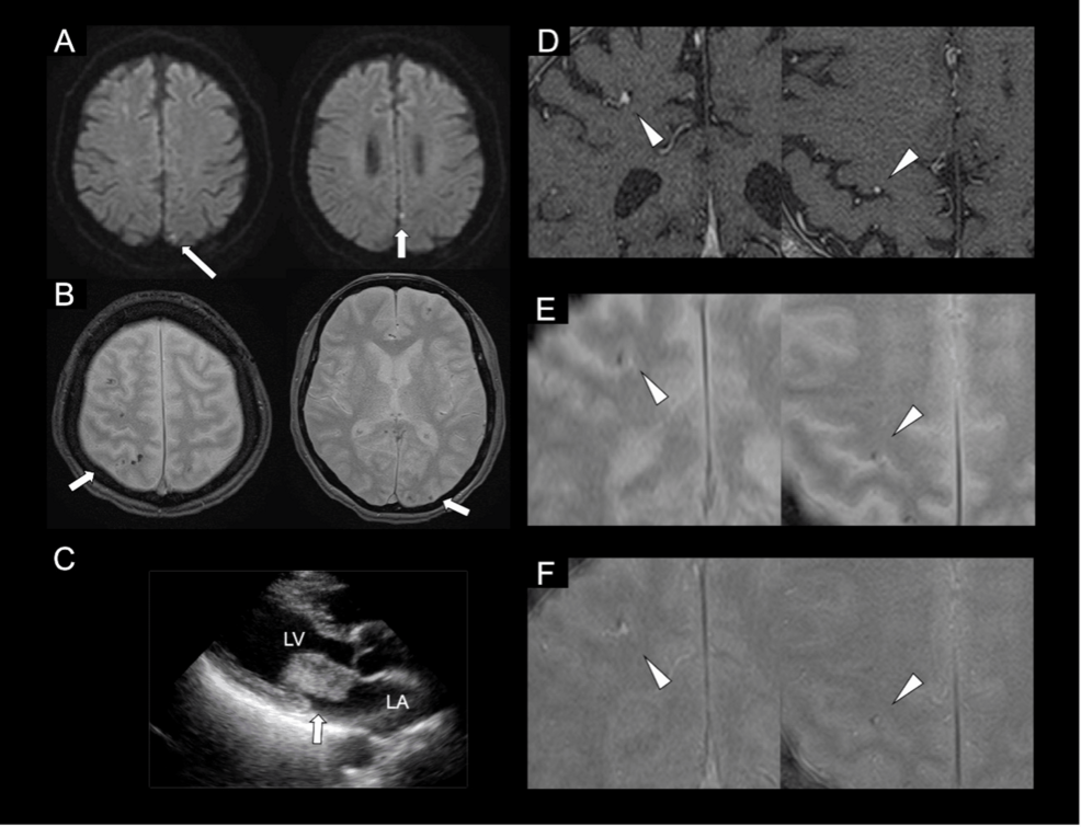 Multiple Cortical Hypointense Lesions Revealed by T2*-Weighted Imaging and Micro-aneurysmal Lesions in a Case of Cardiac Myxoma