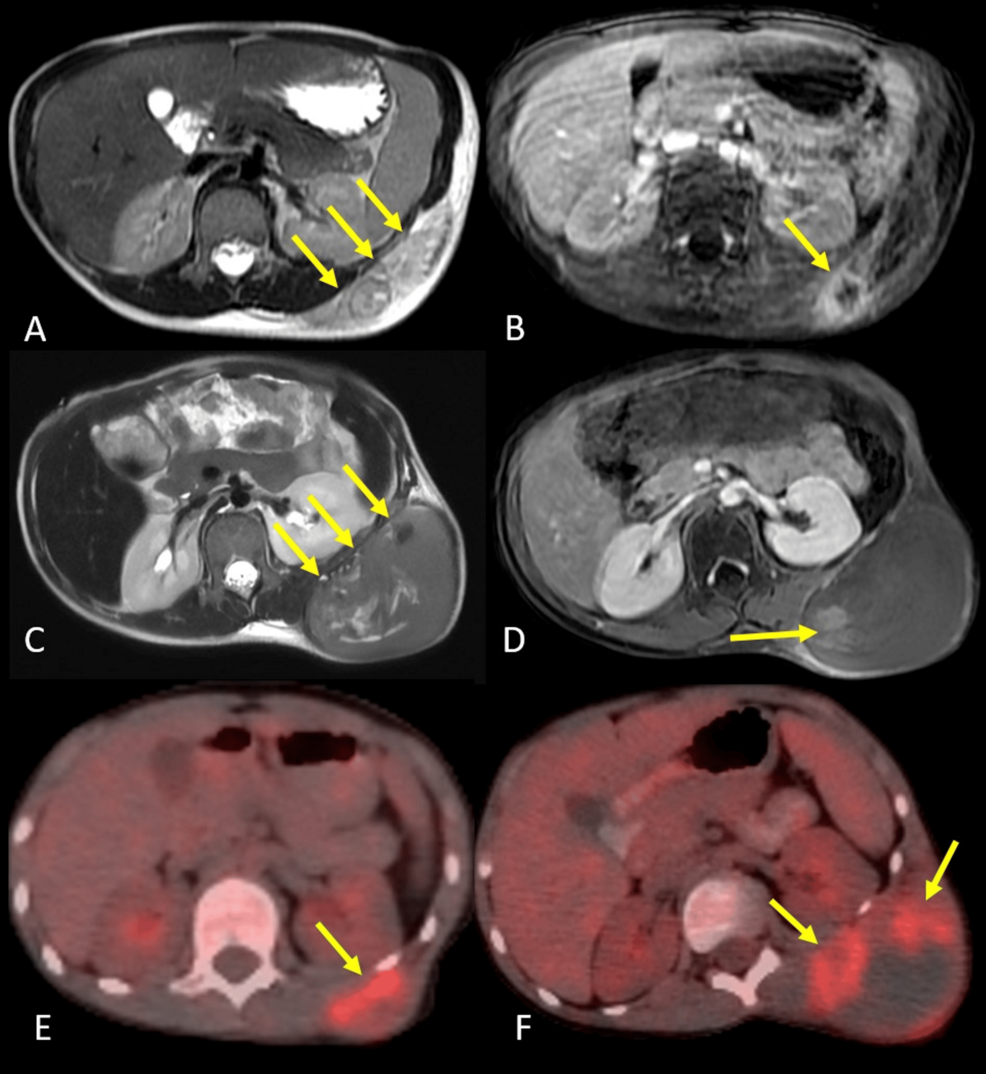 A Case Report of Preoperative Stereotactic Body Radiotherapy as Part of Multimodal Treatment in Pediatric Extraskeletal Ewing Sarcoma: An Innovative Treatment Strategy