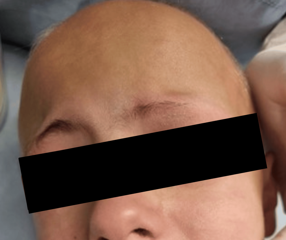 Dental Rehabilitation of a Child Diagnosed With Alopecia Areata Totalis: A Case Report
