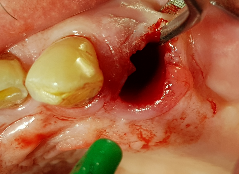 Effectiveness of Biphasic Calcium Sulfate Cement for the Prevention of Local Bleeding After Oral Surgery in Patients on Anticoagulants