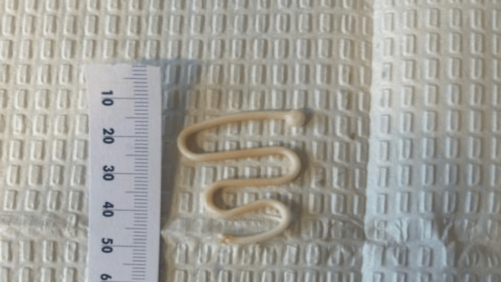 Retained Lippes Loop Intrauterine Device (IUD) in a Woman With Post-menopausal Bleeding and Chronic Pelvic Pain