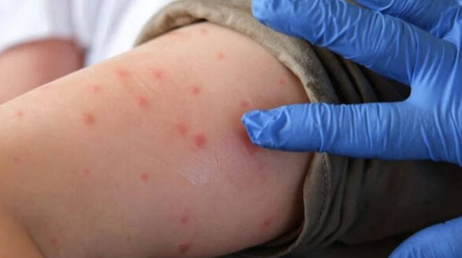 Measles, chickenpox and mumps cases rise among children in Karachi